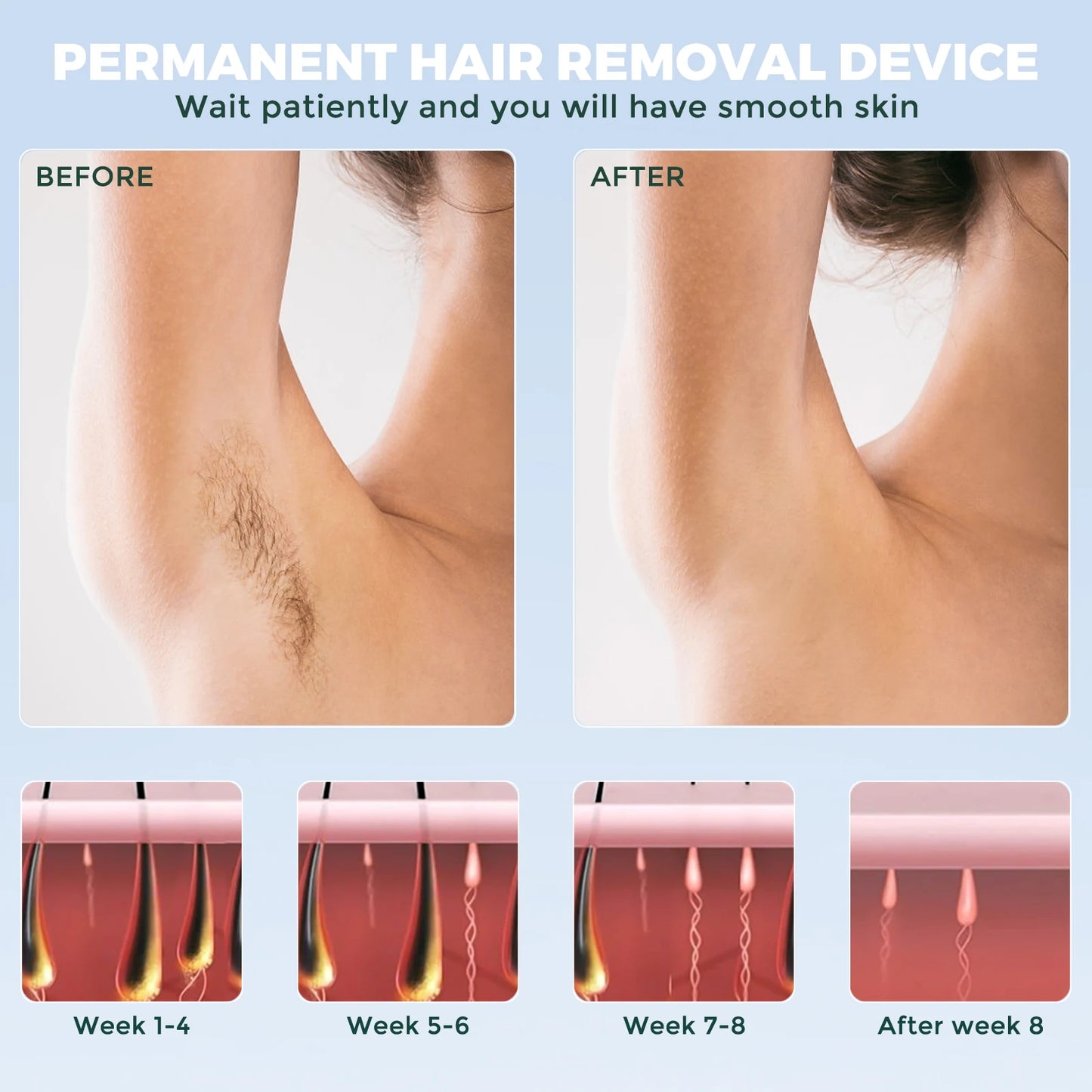 Laser Epilator 5 Modes – Portable & Painless